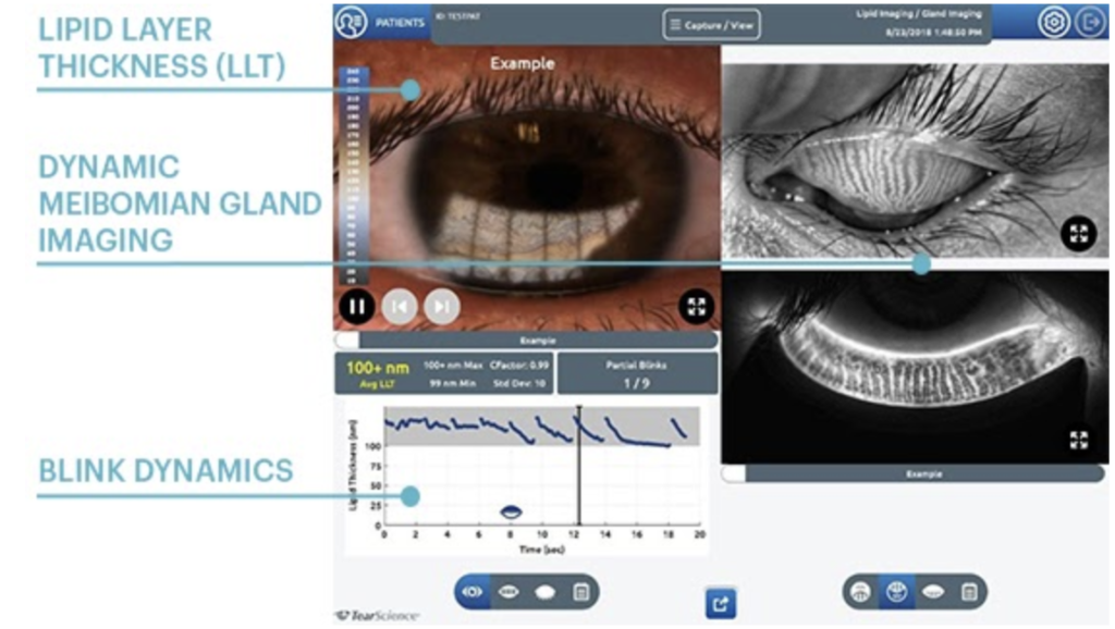 what-a-dry-eye-exam-looks-like-dr-shaver-the-eye-center